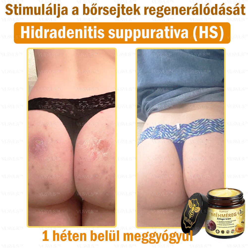 VLSVLS™ Méhméreg Átfogó Krém (Minden korosztály számára alkalmas & HSME ajánlja)